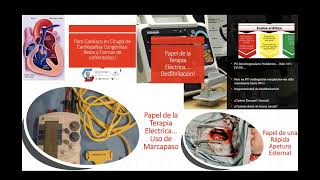 Monitoreo Fisiológico de la RCP QpQs en Cardiopatías Congénitas [upl. by Aivin285]