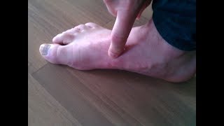 Get Rid Of Blisters On Feet Overnight  Blister Treatment  How To Get Rid Of Blisters On Feet [upl. by Biel916]