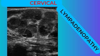 Cervical lymphadenopathy conglomerating nodes on ultrasound scan [upl. by Emeline]