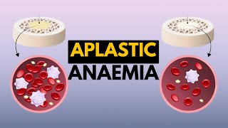 Aplastic Anaemia Causes Signs and Symptoms Diagnosis and Treatment [upl. by Eninotna]