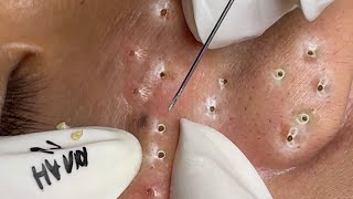 Big Cystic Acne Blackheads Extraction Blackheads amp Milia Whiteheads Removal Pimple Popping  2357 [upl. by Leahcimed]