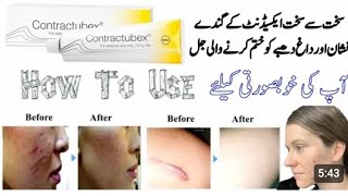 contractubex Gel  how to use contractubex [upl. by Acire205]