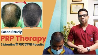 Case Study  PRP Treatment Results after 3 Months  PRP for Hair  Hair Transplant in Delhi [upl. by Zalucki]