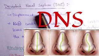 Nasal Septum deviation  DNS  Notes for NEET PG [upl. by Sande]