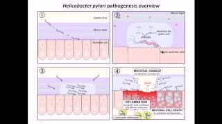 Helicobacter pylori infection and diseases [upl. by Samot]