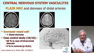 Vascularite cérébralevascularite du système nerveux central 1ère partie [upl. by Maude101]