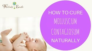 How To Cure Molluscum Contagiosum Naturally [upl. by Learsiy]