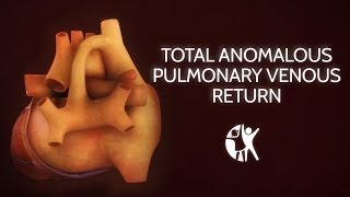 Total Anomalous Pulmonary Venous Return [upl. by Laetitia491]