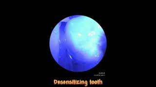 Desensitize tooth [upl. by Bruis]