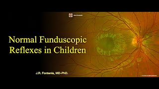 Normal Funduscopic Reflexes in Children [upl. by Ssecnirp]