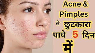 कील मुहासो acne की दवा Clindamycin phosphate gel  usesmechanism of action  Clinsol Gel review [upl. by Garratt]