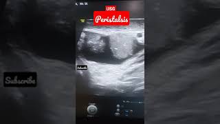 BOWEL LOOPS SHOWING PERISTALSIS IN ULTRASOUND🙂 [upl. by Janene]