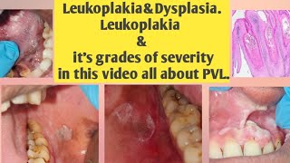 Leukoplakia and DysplasiaLeukoplakia amp its grades of severitythis video all type Leukoplakiaamp PVL [upl. by Nnav148]