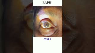 RAPD testing  Optic nerve test  Swinging flash light test eyecareoptom shorts rapd short eye [upl. by Arbe]