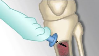 quotPlacement of an Intraosseous Linequot by Monica Kleinman MD for OPENPediatrics [upl. by Ally]