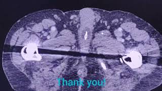 Malposition of Folley catheter  the importance to check   CT findings [upl. by Novej]