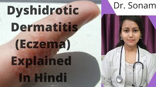 Dyshidrotic Eczema  Causes  Symptoms  Diagnosis amp Treatment [upl. by Zia631]