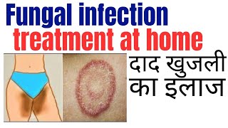 Fungal infection treatment at home  Khujli ki medicine  Daad ki best medicine [upl. by Odrick]