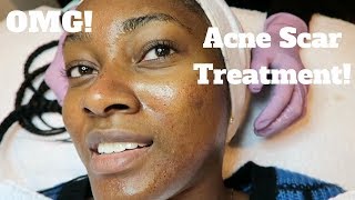 My Dermatology Acne Scar Treatment  Microneedling Experience [upl. by Berry]