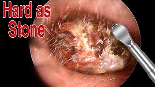 BIGGEST Ear Wax Difficult Removal  EP2  Doctor Anh [upl. by Naffets]