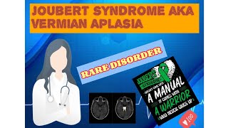 Joubert syndrome  vermian Aplasia  Rare genetic disorder  Molar Tooth 🦷  Case study 🧠 [upl. by Lynnea]