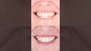 ORTODONTIA E ESTÉTICA DENTAL dentista invisalign facetas [upl. by Nolubez]