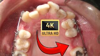 Ectopic canines in ADULTS and WISDOM tooth eruption Braces time lapse [upl. by Ordnaxela]