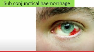 Sub conjunctival hemorrhage explained [upl. by Lissa]