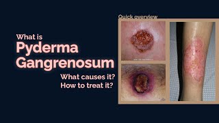 Pyoderma Gangrenosum [upl. by Inalan]