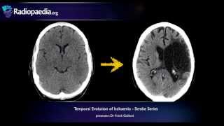 Stroke Evolution from acute to chronic infarction  radiology video tutorial CT MRI [upl. by Irrabaj]