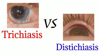 Difference between trichiasis and distichiasis  optometry club [upl. by Macmillan]