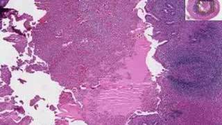 Histopathology Acute Appendicitis [upl. by Eisak]