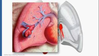 IVC Filters [upl. by Odella]