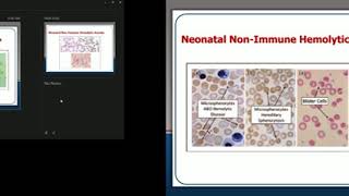 Non Immune Hemolytic Anemia Prof Dr Naglaa Shaheen [upl. by Nason882]