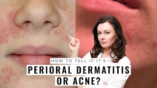 Perioral Dermatitis or Acne How to Tell the Difference  Dr Sam Bunting [upl. by Natsrik424]