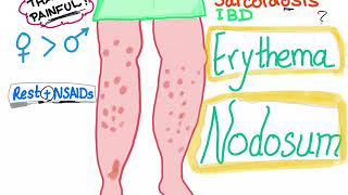 Erythema Nodosum [upl. by Mahoney]