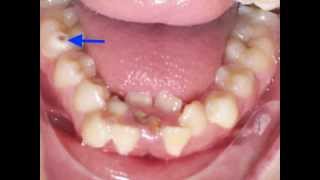 Lower Incisor Extraction Time Lapse Video Kyger Orthodontics [upl. by Fanchet171]