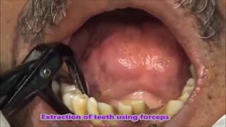 Chronic Periodontitis Extraction of lower teeth [upl. by Auoh]