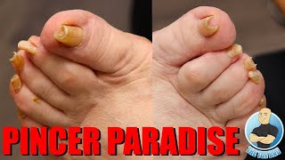 TRIMMING OF SUPER CURVED PINCER TOENAILS [upl. by Pazia668]