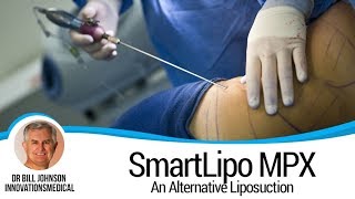 Dr Bill Johnson Features SmartLipo MPX Alternative Liposuction on Fox 4 News [upl. by Rockwell]