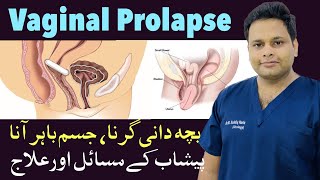 Vaginal Prolapse  Cystocele  Bacha Dani Ka Jism Se Baher Aana  Bacha Dani Gir jana [upl. by Aitan]