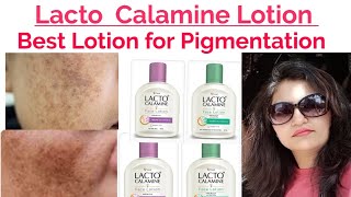 Best Lotions Lacto Calamine for pigmentation pimples 21 days pigmentation Challenge simple diets fa [upl. by Jarrett]