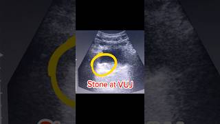 Ureteric Stone  VUJ Stone  Bladder Stone on Ultrasound [upl. by Nnyrat]