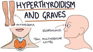 Understanding Hyperthyroidism and Graves Disease [upl. by Olli870]