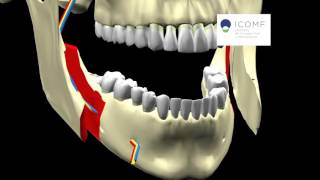 PROGNATISMO MANDIBULAR  OSTEOTOMIA SAGITAL [upl. by Arahs954]