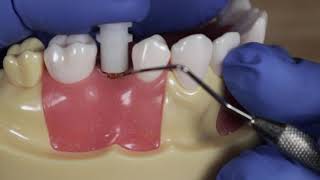 Closed Tray Impression Coping  How to Take A Closed Tray Impression [upl. by Kcid]