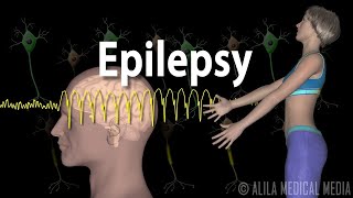 Epilepsy Types of seizures Symptoms Pathophysiology Causes and Treatments Animation [upl. by Sweatt]