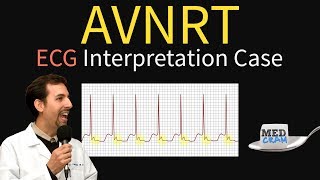 AV Nodal Reentry Tachycardia AVNRT on ECG  EKG [upl. by Bourke59]