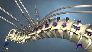 Correcting Kyphosis with the MESA Rail™ Deformity Spinal System [upl. by Chappie]