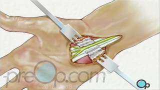 Carpal Tunnel Syndrome Surgery  PreOp Patient Education [upl. by Smitty]